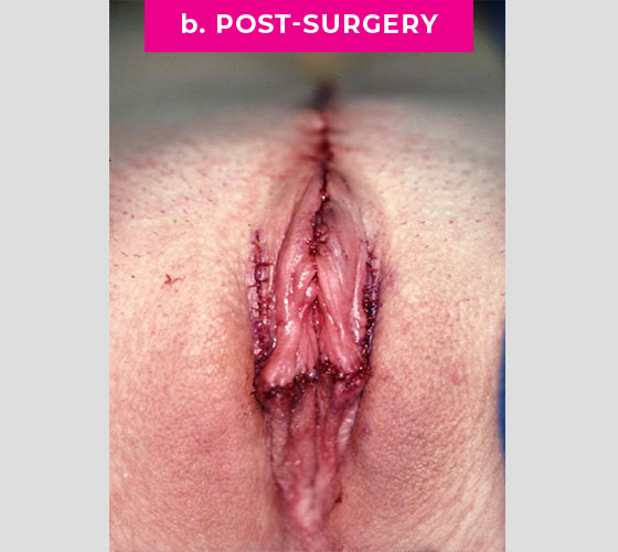 INTERSEX & COMPLEX FEMALE RECONSTRUCTION Patient 7 After